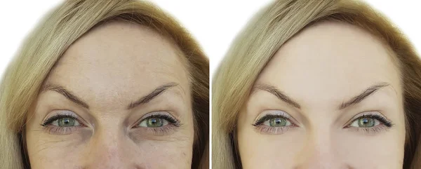 Gesicht Der Frauenfalte Vor Und Nach Den Augen — Stockfoto