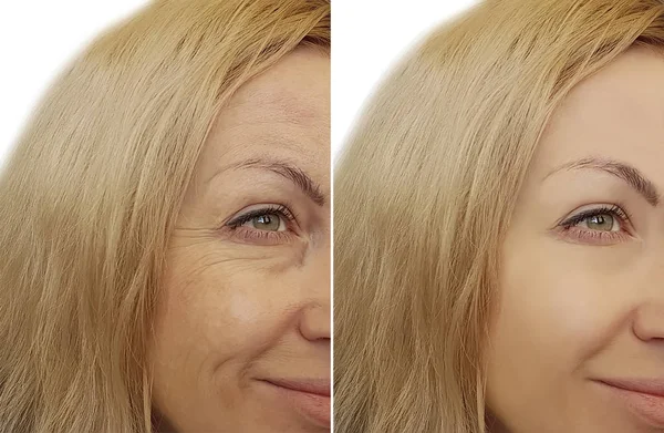 Arrugas Cara Mujer Antes Después —  Fotos de Stock