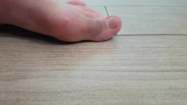 bacak eklemin deformasyon
