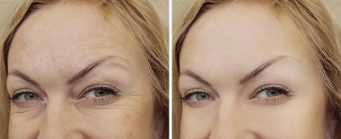 yüz kadın kırışıklıklar önce ve sonra