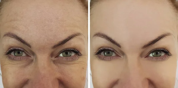 Cara Mulher Rugas Olhos Antes Depois — Fotografia de Stock