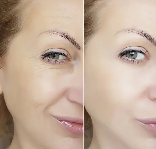 Cara Mujer Arrugas Ojos Antes Después —  Fotos de Stock