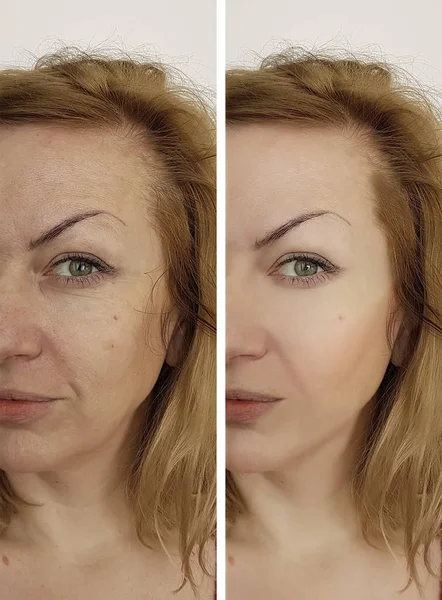 Wanita Wajah Sebelum Dan Setelah Prosedur Kosmetik — Stok Foto