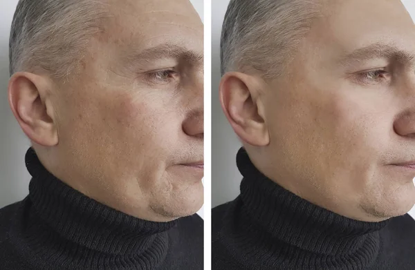 Yüz Adam Kırışıklıklar Önce Sonra — Stok fotoğraf