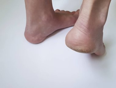 topuklar üzerinde beyaz bir arka plan üzerinde çatlaklar