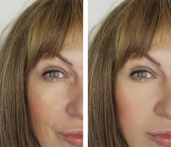 face woman wrinkles before and after procedures
