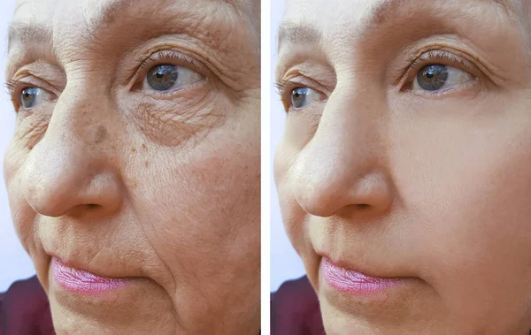 Woman Face Wrinkles Procedures — Stock Photo, Image