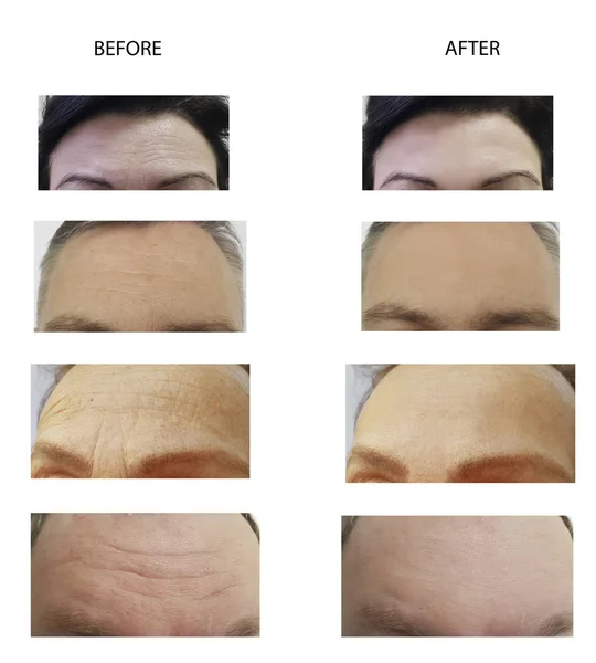 forehead wrinkles man and woman before and after