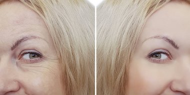 kadın yüz kırışıklıklar önce ve sonra