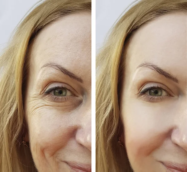 woman face wrinkles before and after