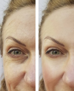 yüz kadın kırışıklıklar önce ve sonra