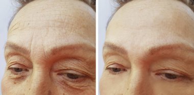yüz kadın yaşlı kırışıklıklar daha önce ve sonra
