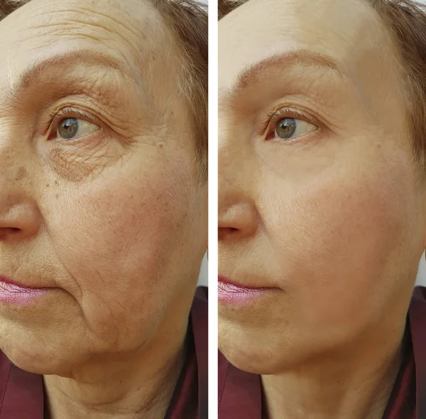 Cara Mujer Anciana Arrugas Antes Después — Foto de Stock