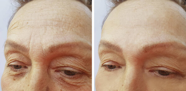 лицо женщины пожилого возраста морщины до и после
