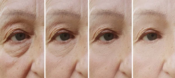 Стара Жінка Зморщує Очі Після Лікування — стокове фото