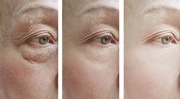 Mulher Velha Rugas Olhos Antes Depois Tratamento — Fotografia de Stock