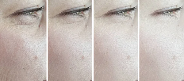 Augenfältchen Vor Und Nach Der Behandlung — Stockfoto