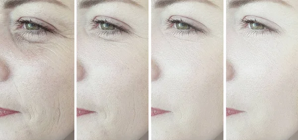 Kadın Gözü Tedaviden Önce Sonra Kırışıyor — Stok fotoğraf