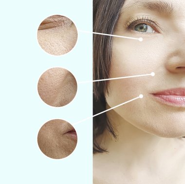 Kadın tedaviden önce ve sonra kırışıklıklarla karşılaşır