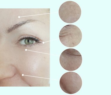 kadın kırışıklıkları yüz işlemden önce ve sonra