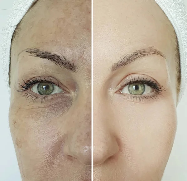 Arrugas Mujer Cara Antes Después Del Tratamiento —  Fotos de Stock