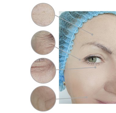 kadın kırışıklıkları yüz işlemden önce ve sonra