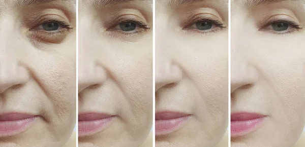 woman face wrinkles before and after treatment collage