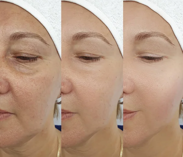 Woman Face Wrinkles Treatment — Stock Photo, Image