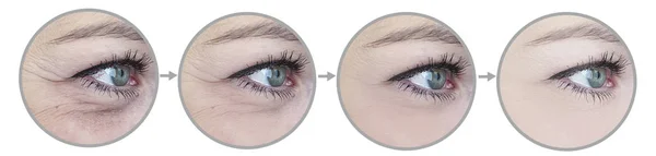 Rugas Dos Olhos Mulher Antes Depois Colagem Tratamento — Fotografia de Stock