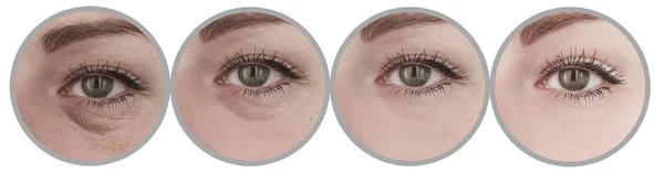 Rugas Dos Olhos Mulher Antes Depois Colagem Tratamento — Fotografia de Stock