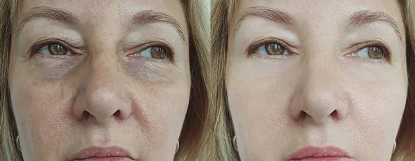 Elderly Woman Face Wrinkles Treatment — Stock Photo, Image