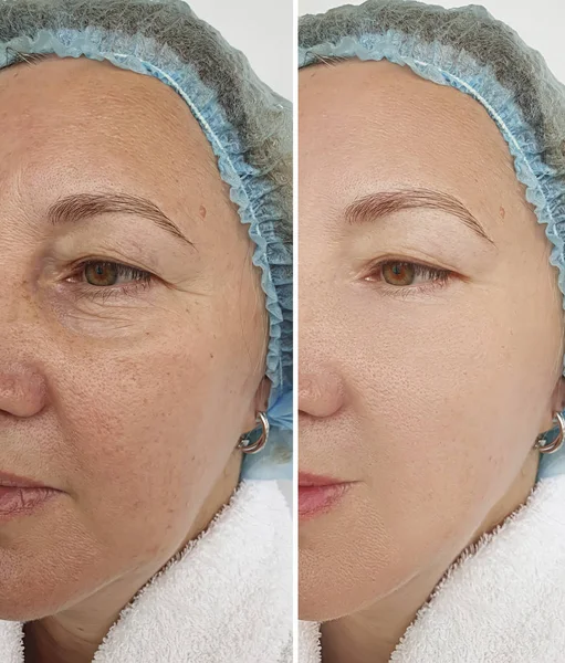 Elderly Woman Face Wrinkles Treatment — Stock Photo, Image