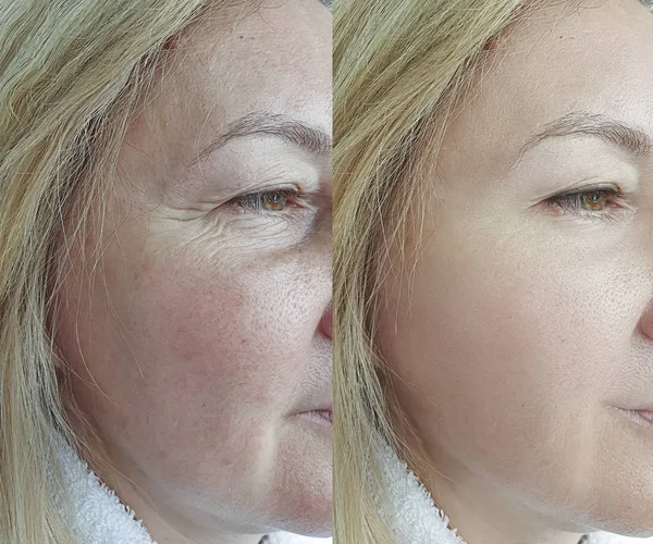 elderly woman face wrinkles before and after treatment