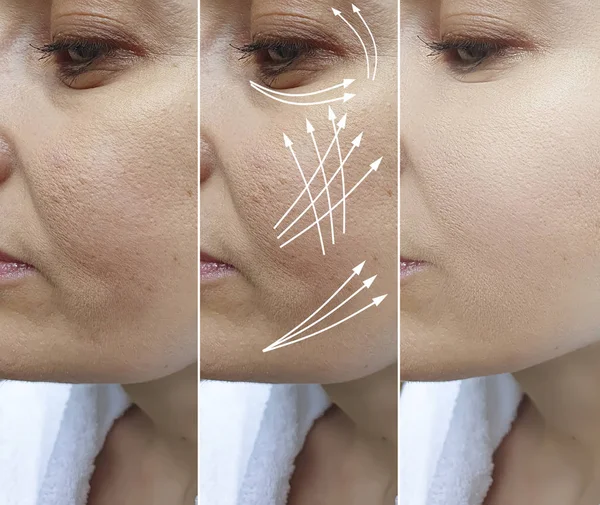 woman wrinkles face before and after treatment arrow, thread lifting