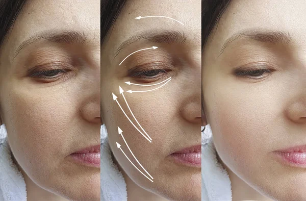 woman wrinkles face before and after treatment arrow, thread lifting