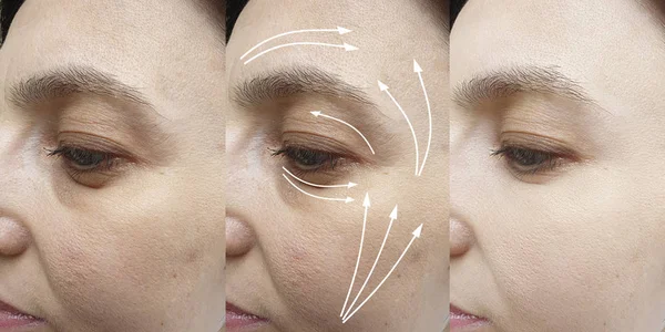 Woman Wrinkles Face Treatment Arrow — Stock Photo, Image