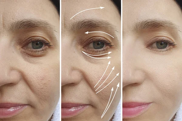 woman wrinkles face before and after treatment arrow