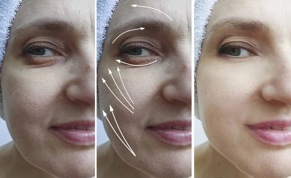 woman wrinkles face before and after treatment arrow