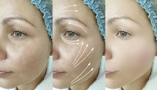 Woman Wrinkles Face Treatment Arrow — Stock Photo, Image