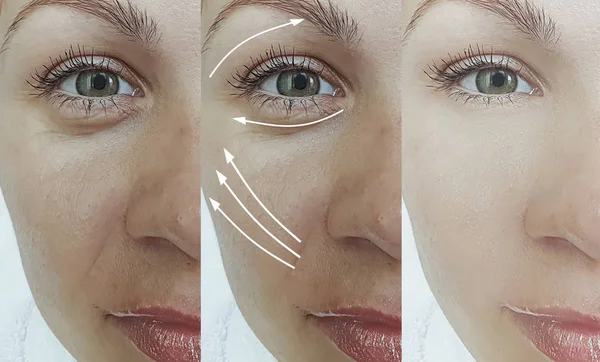 Frau Falten Gesicht Vor Und Nach Der Behandlung Pfeil — Stockfoto