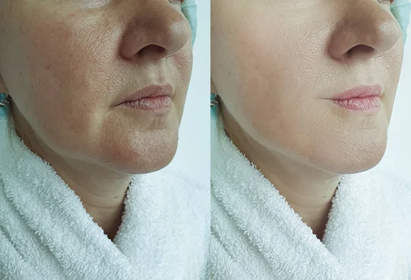 Arrugas Mujer Cara Antes Después Del Tratamiento — Foto de Stock