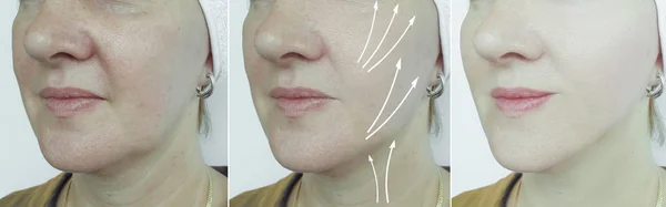 woman wrinkles face before and after treatment