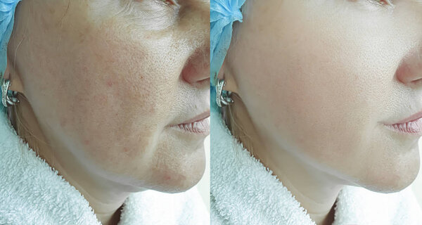 woman wrinkles face before and after treatment
