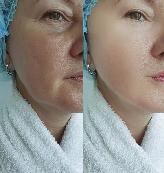 woman wrinkles face before and after treatment