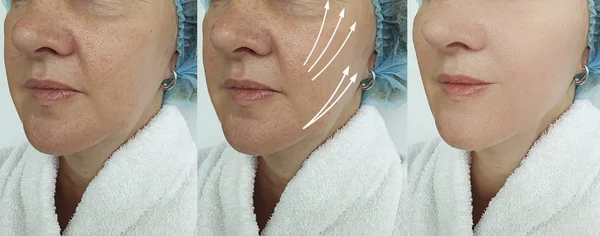 Elderly Woman Face Wrinkles Treatment — Stock Photo, Image