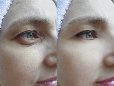 Yaşlı kadın yüz önce ve tedavi sonrası kırışıklıkları