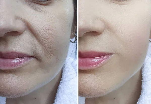 Arrugas Cara Mujer Mayor Antes Después Del Tratamiento —  Fotos de Stock