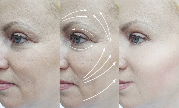 Arrugas Faciales Mujer Antes Después Del Tratamiento — Foto de Stock