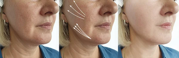 Elderly Woman Face Wrinkles Treatment Arrow — Stock Photo, Image