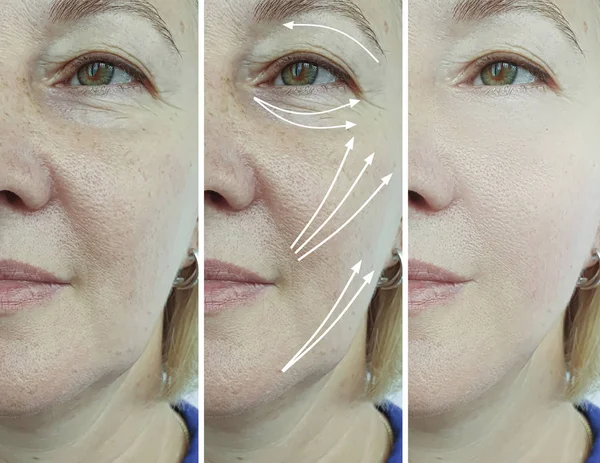 治療前と治療後の高齢女性の顔しわ矢印 — ストック写真